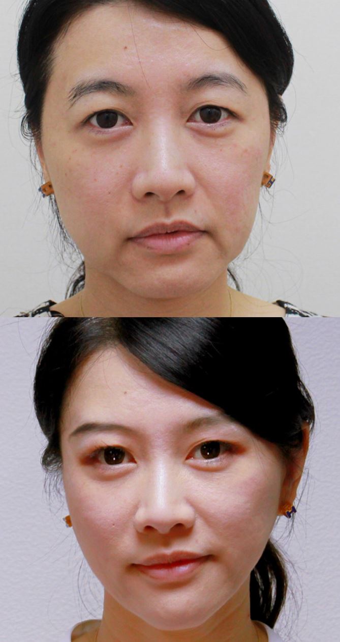 Paciente tratada com 10 ml de Ellansé na Clínica Avallon — comparação antes e depois de 12 meses