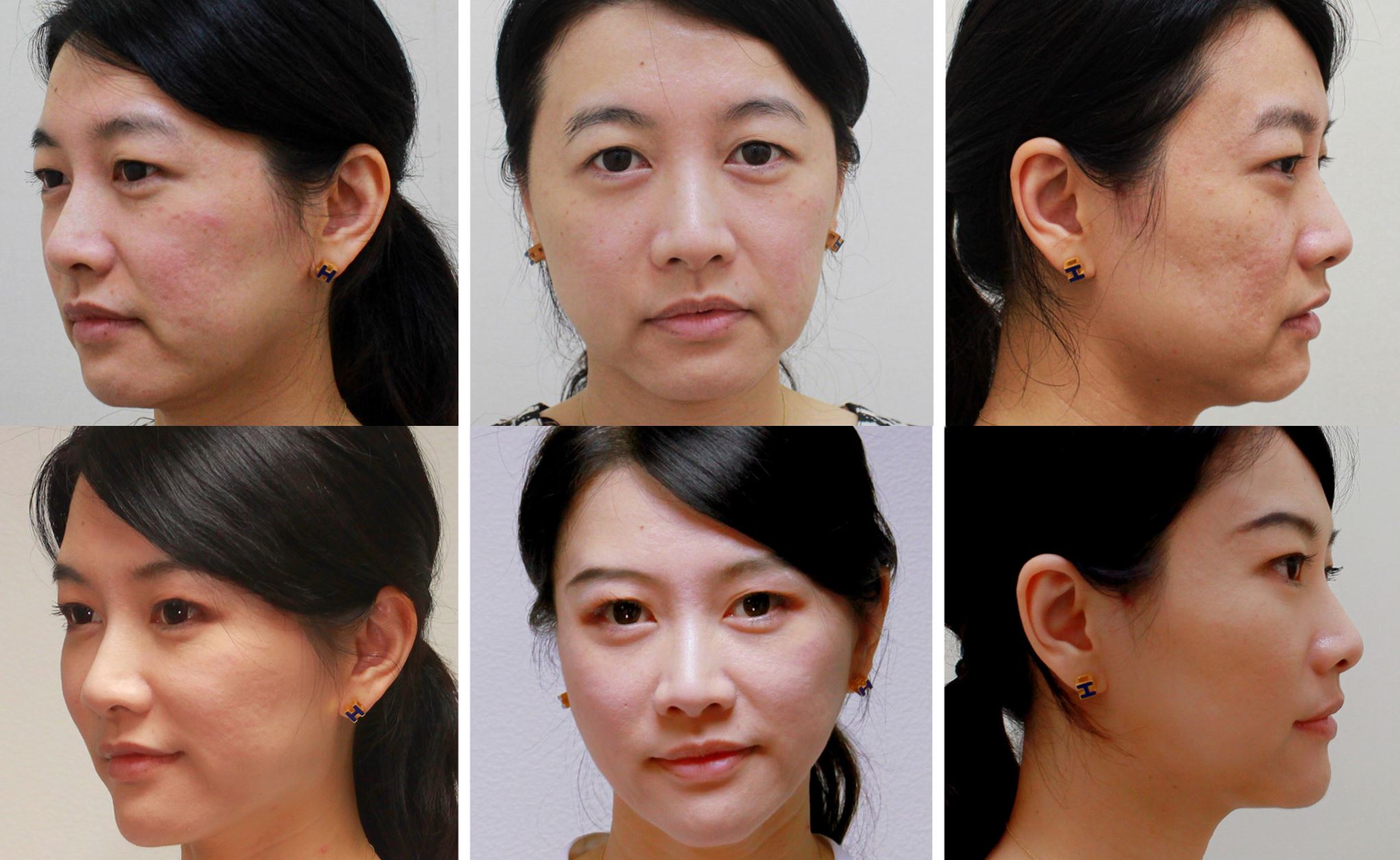 Paciente tratada com Ellansé — resultado de rejuvenescimento facial antes e depois, Clínica Avallon Brasília