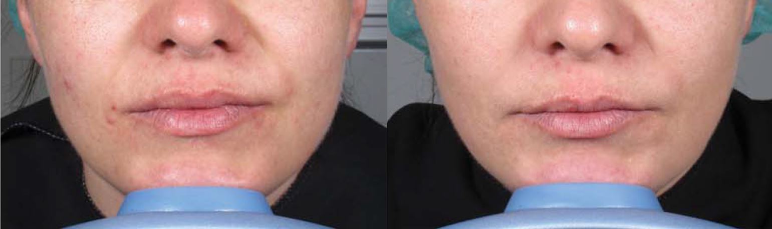 Paciente tratada com Ellansé em sulco nasogeniano — comparação antes e depois de 18 meses, Clínica Avallon Brasília