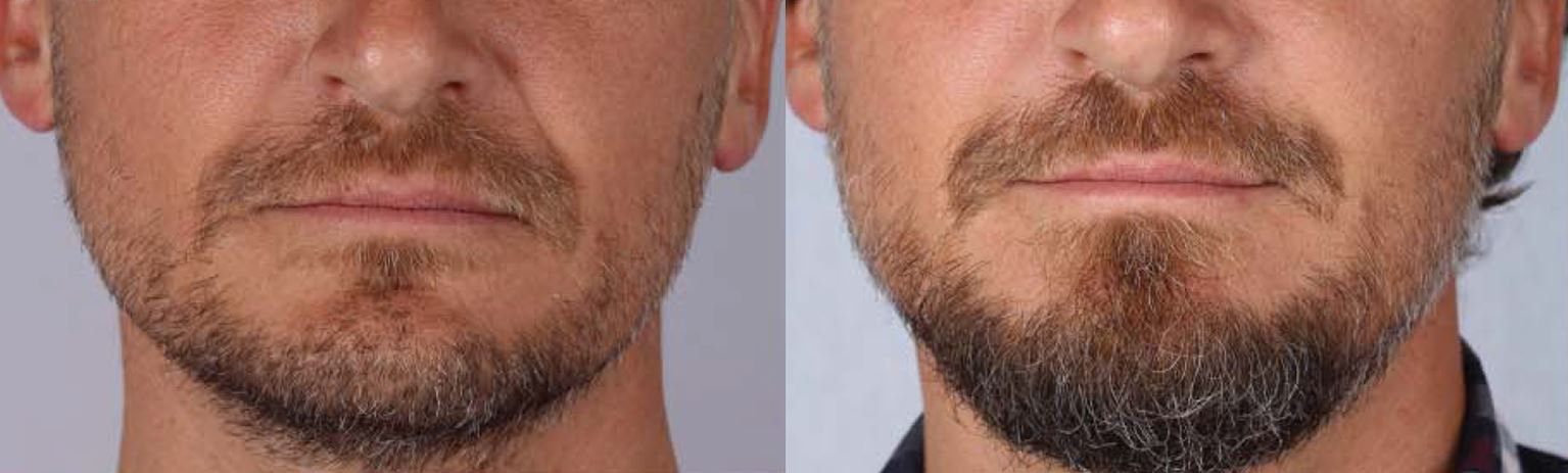 Paciente tratado com Ellansé em sulco nasogeniano (bigode chinês) — comparação antes e depois de 18 meses, Clínica Avallon Brasília