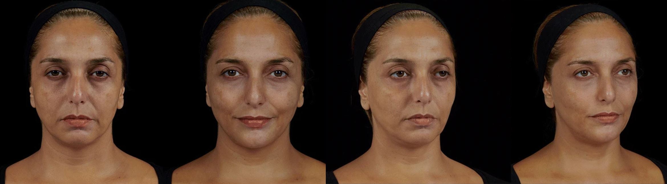 Paciente após preenchimento facial completo com 15 mL de ácido hialurônico — antes e depois, Clínica Avallon Brasília