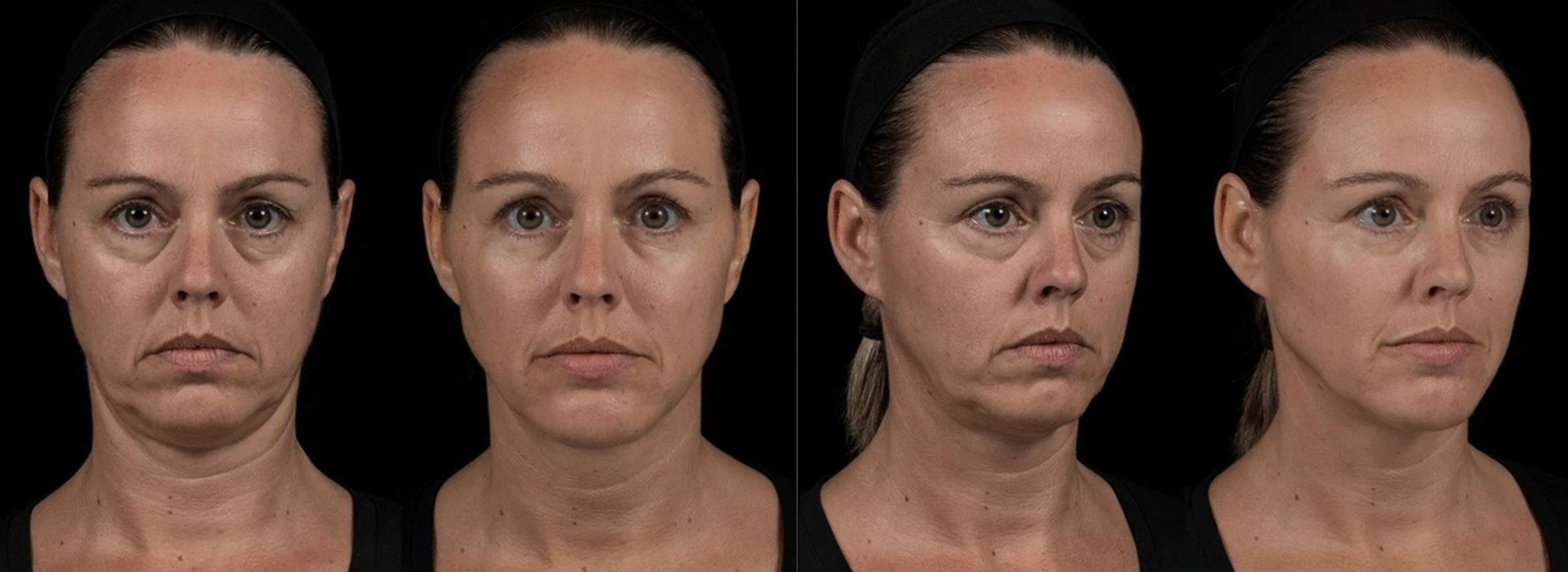 Paciente após preenchimento facial completo com 16 mL de ácido hialurônico — antes e depois, Clínica Avallon Brasília