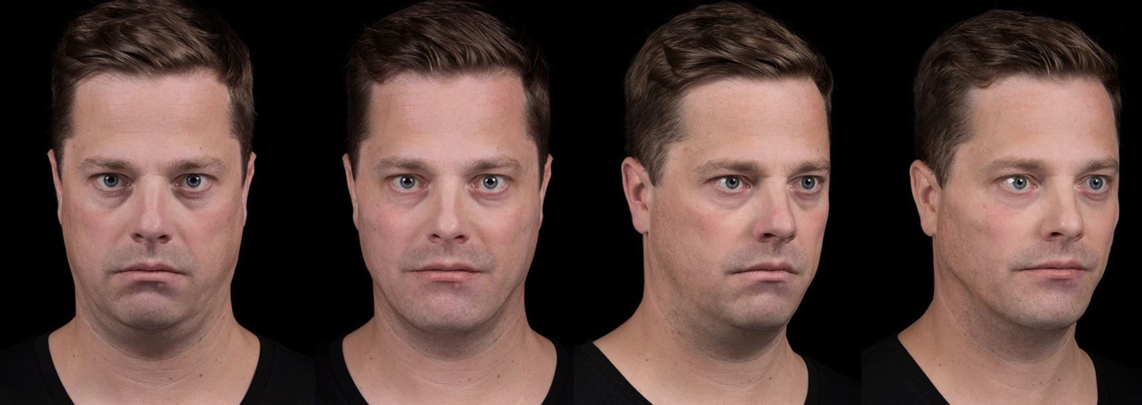 Paciente após preenchimento facial completo com 20 mL de ácido hialurônico — antes e depois, Clínica Avallon Brasília