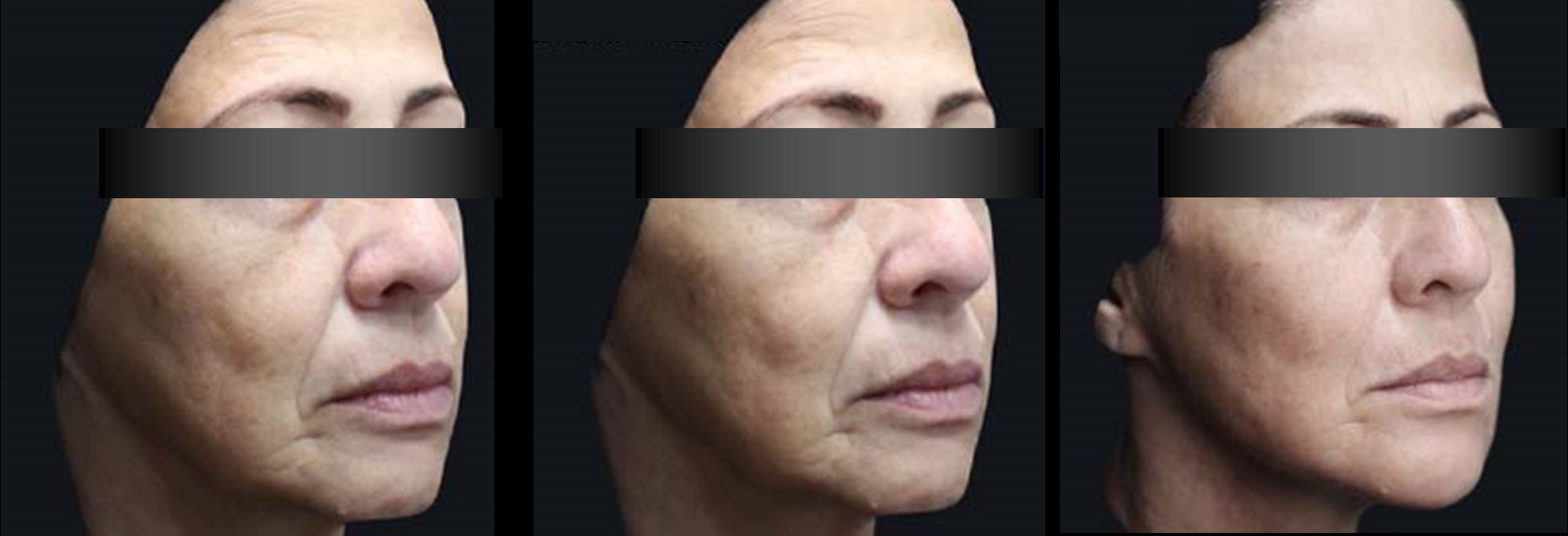 Paciente tratada com HArmonyCa — antes e depois 150 dias, Clínica Avallon, Brasília