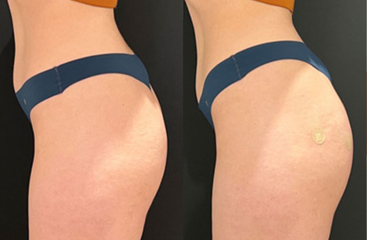 Resultado de preenchimento glúteo com ácido hialurônico corporal — antes e depois