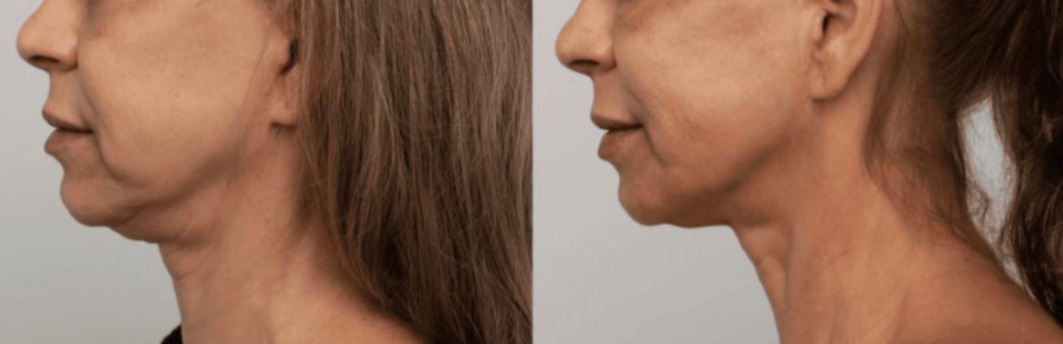Paciente tratada com hidroxiapatita de cálcio em região cervical — antes e depois 12 meses