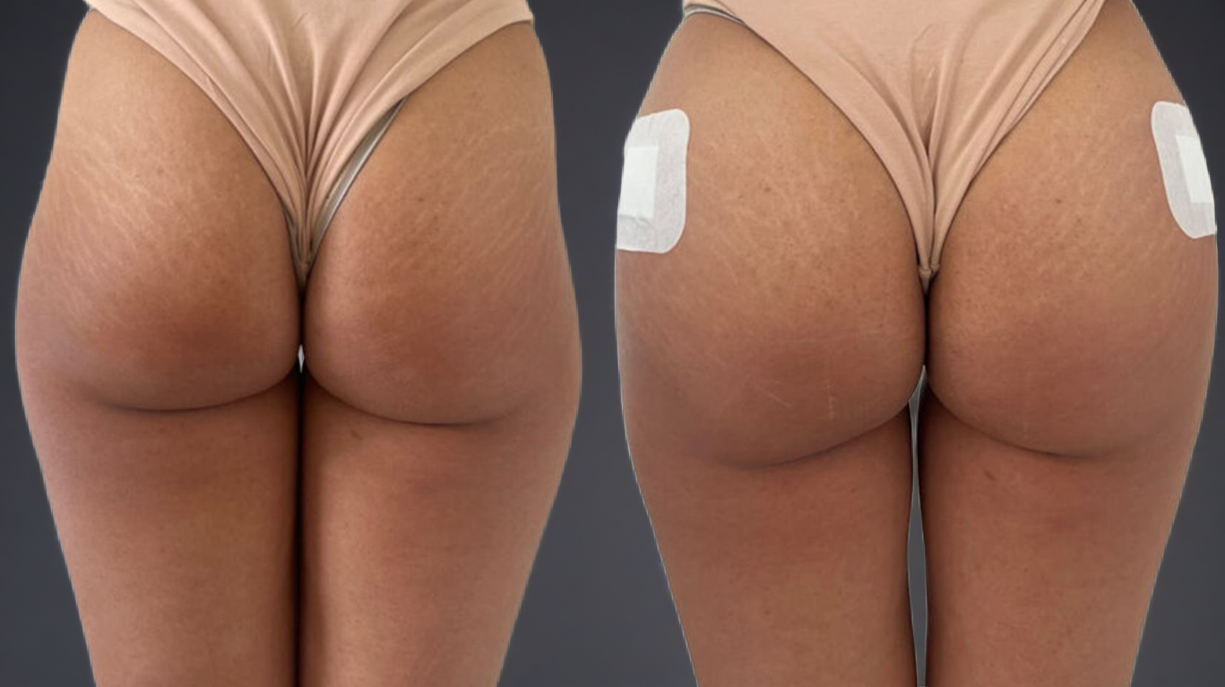 Harmonização glútea com ácido hialurônico — paciente antes e depois do procedimento na Clínica Avallon, Brasília